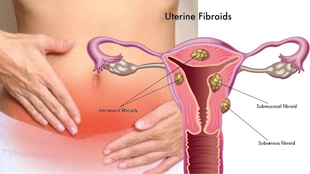 Hormones Connected To Increased Risks Of Uterine Fibroids 