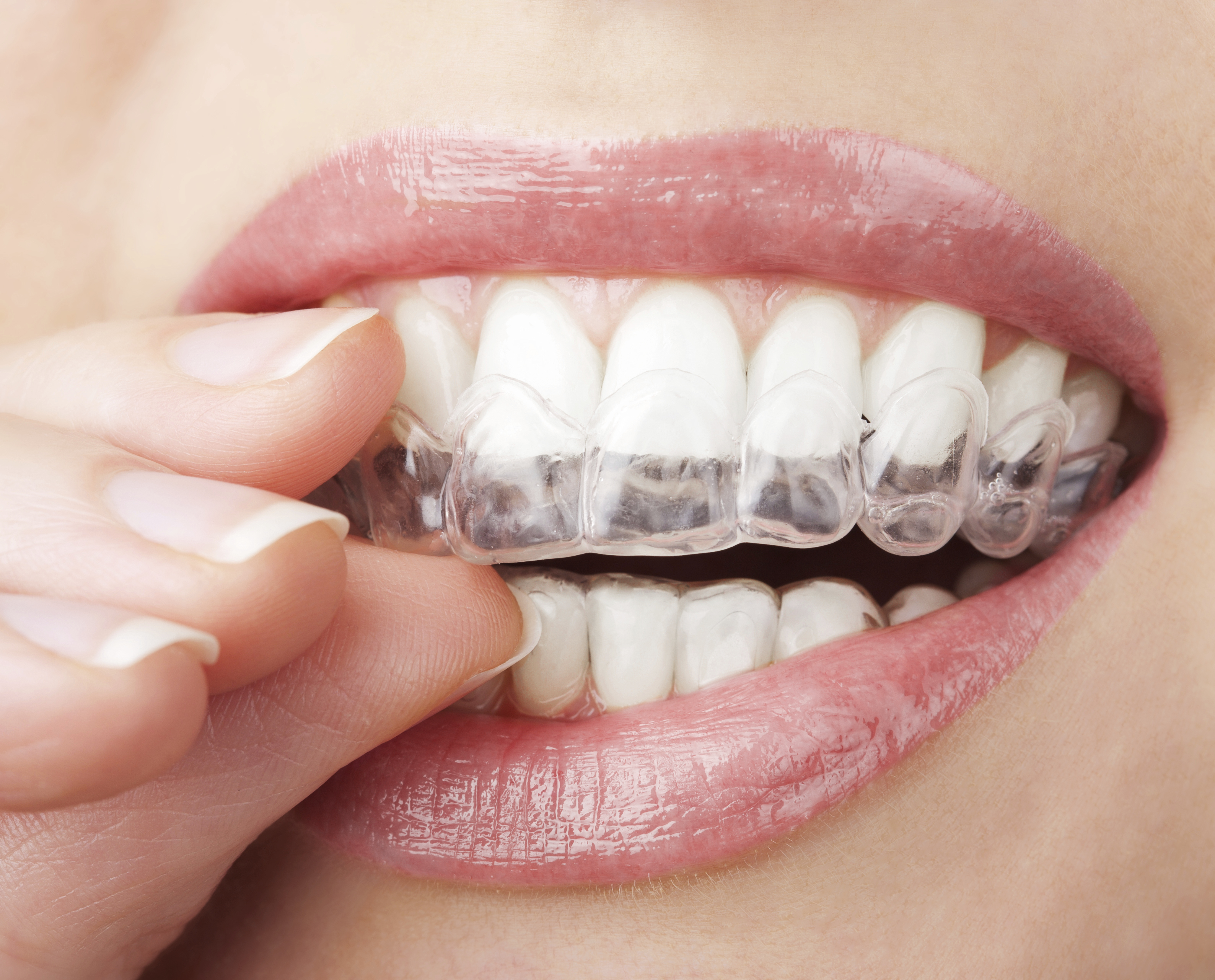 Consider Invisalign As The Best Advancement In Dental History